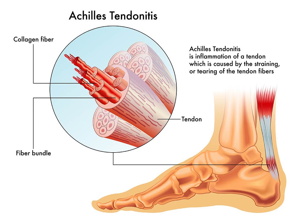 achilles tendonitis