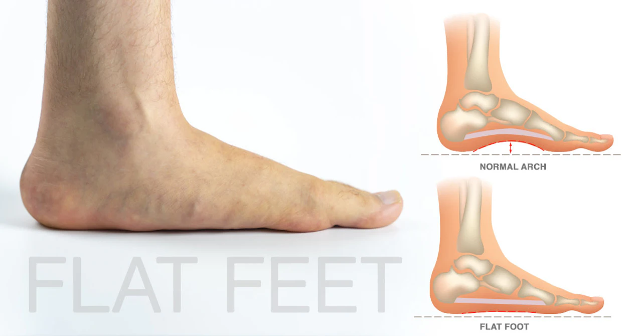 Custom insoles for flat feet