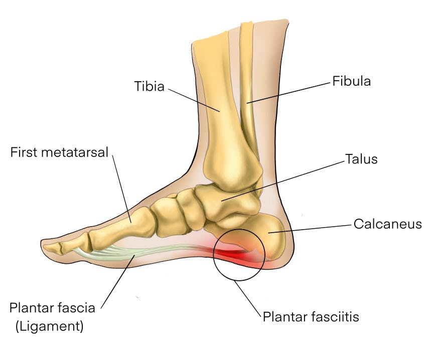 Plantar fasciitis heel pain causes