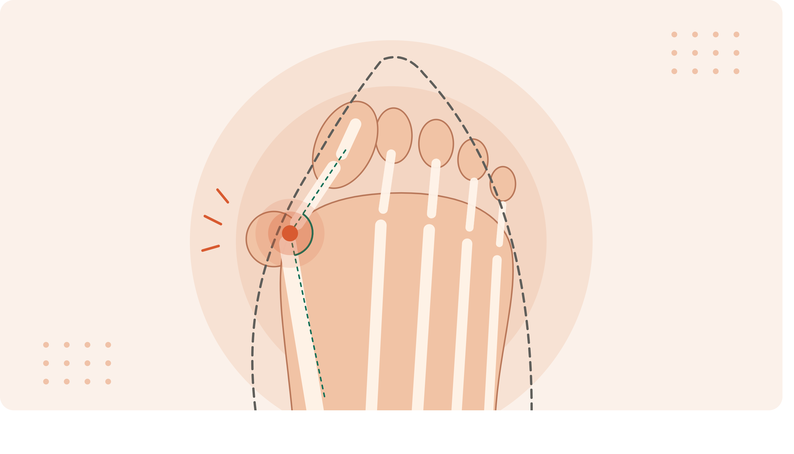Close-up illustration of a bunion, showing the big toe joint angled out and a narrow shoe pressing on the painful bump.