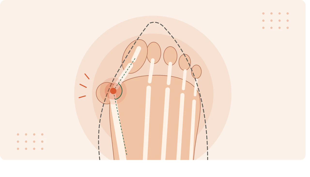 Close-up illustration of a bunion, showing the big toe joint angled out and a narrow shoe pressing on the painful bump.