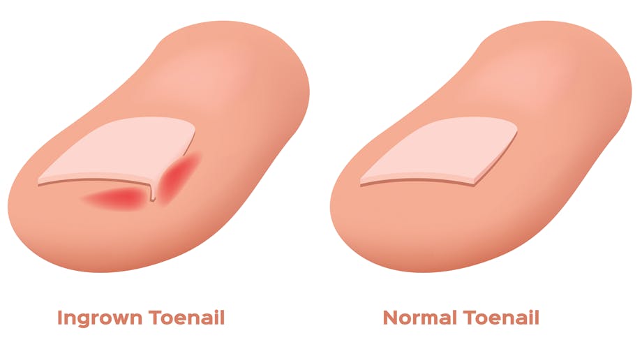 Ingrown Toenails and Nail Surgery | Foot Right Podiatry