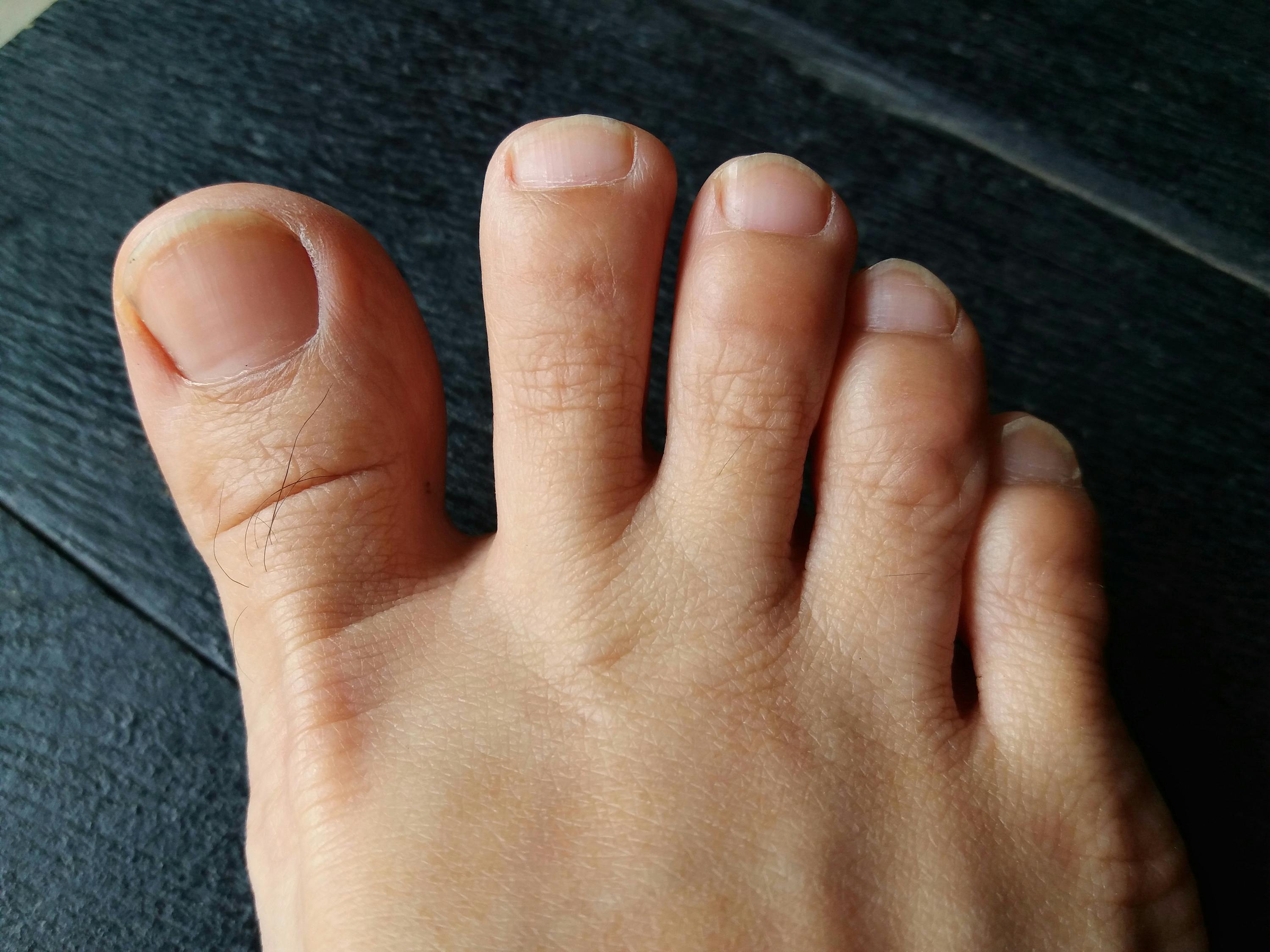 10. The Role of Diet in Maintaining Healthy Toe Nail Color - wide 4