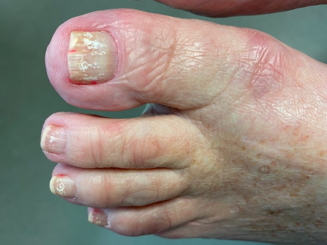 Why are my toenails yellow: Causes and treatment