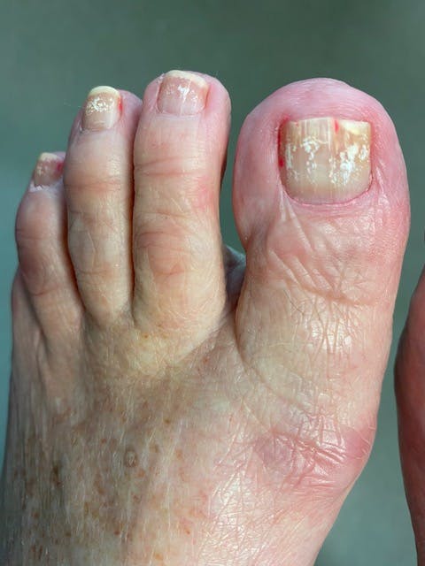 toenail polish fungus