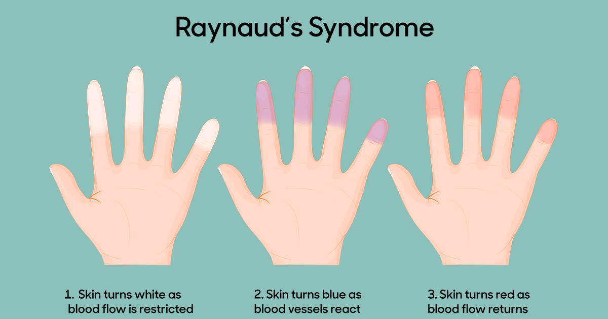 Raynaud’s Phenomenon | Foot Right Podiatry