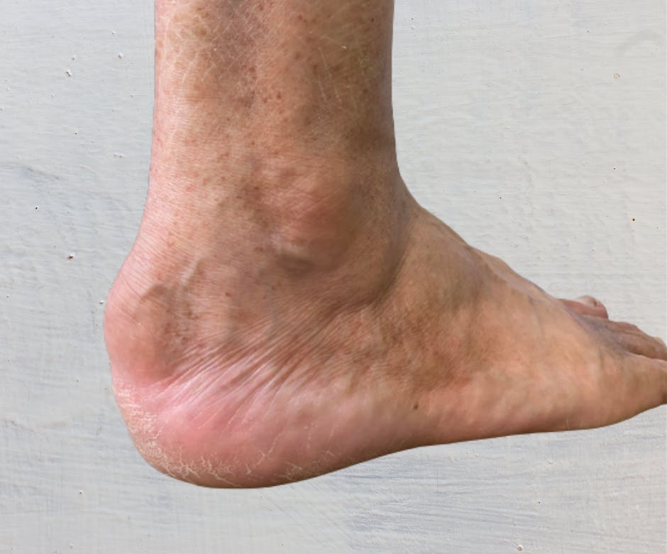 What is that lump on the back of my heel? Foot Right Podiatry