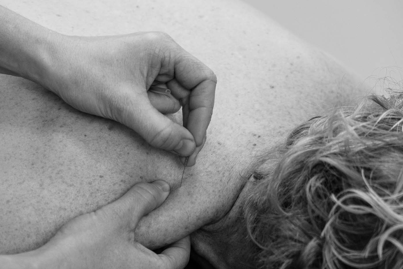 Dry Needling