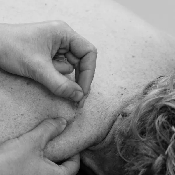 Dry Needling