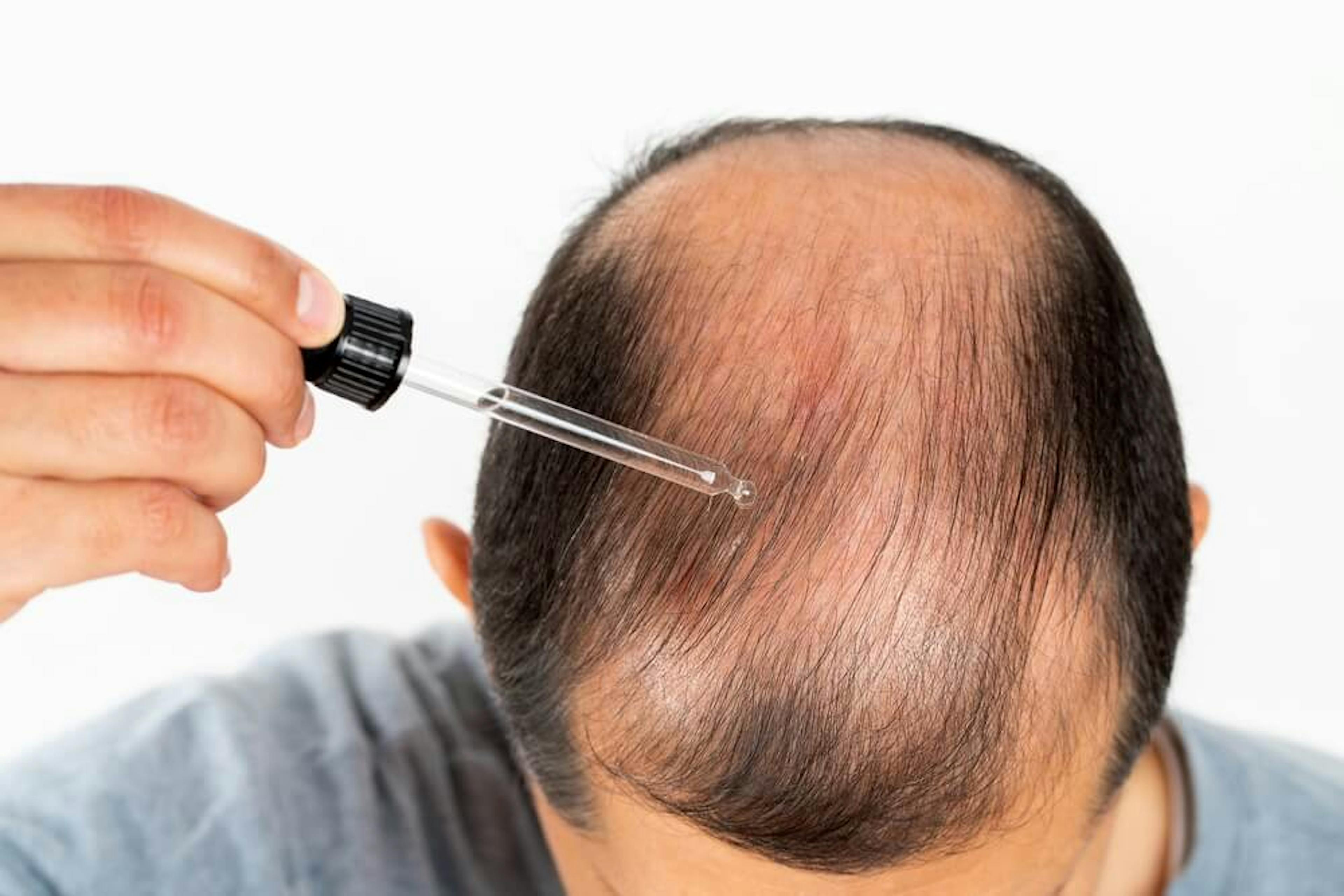 Minoxidil Solution