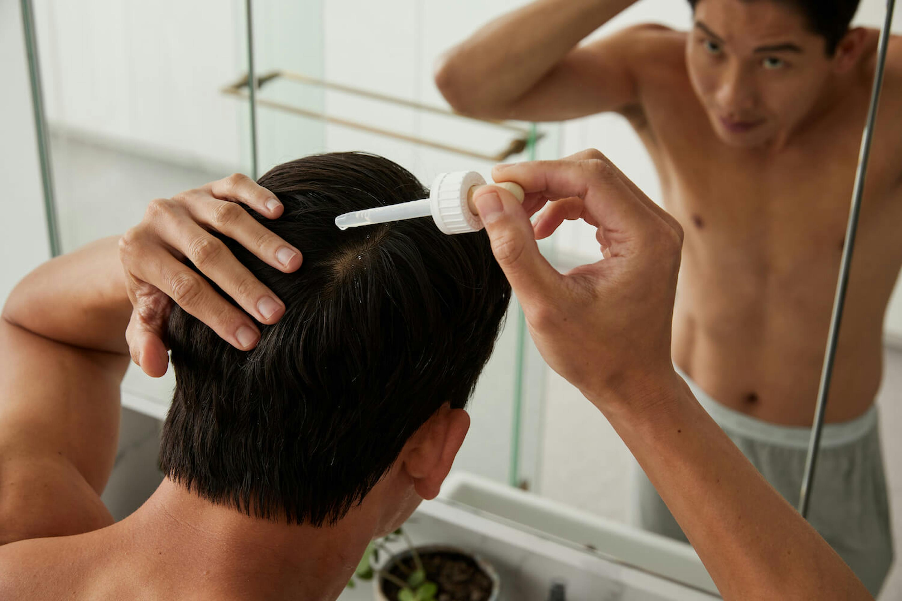 Receding Hairline Treatment