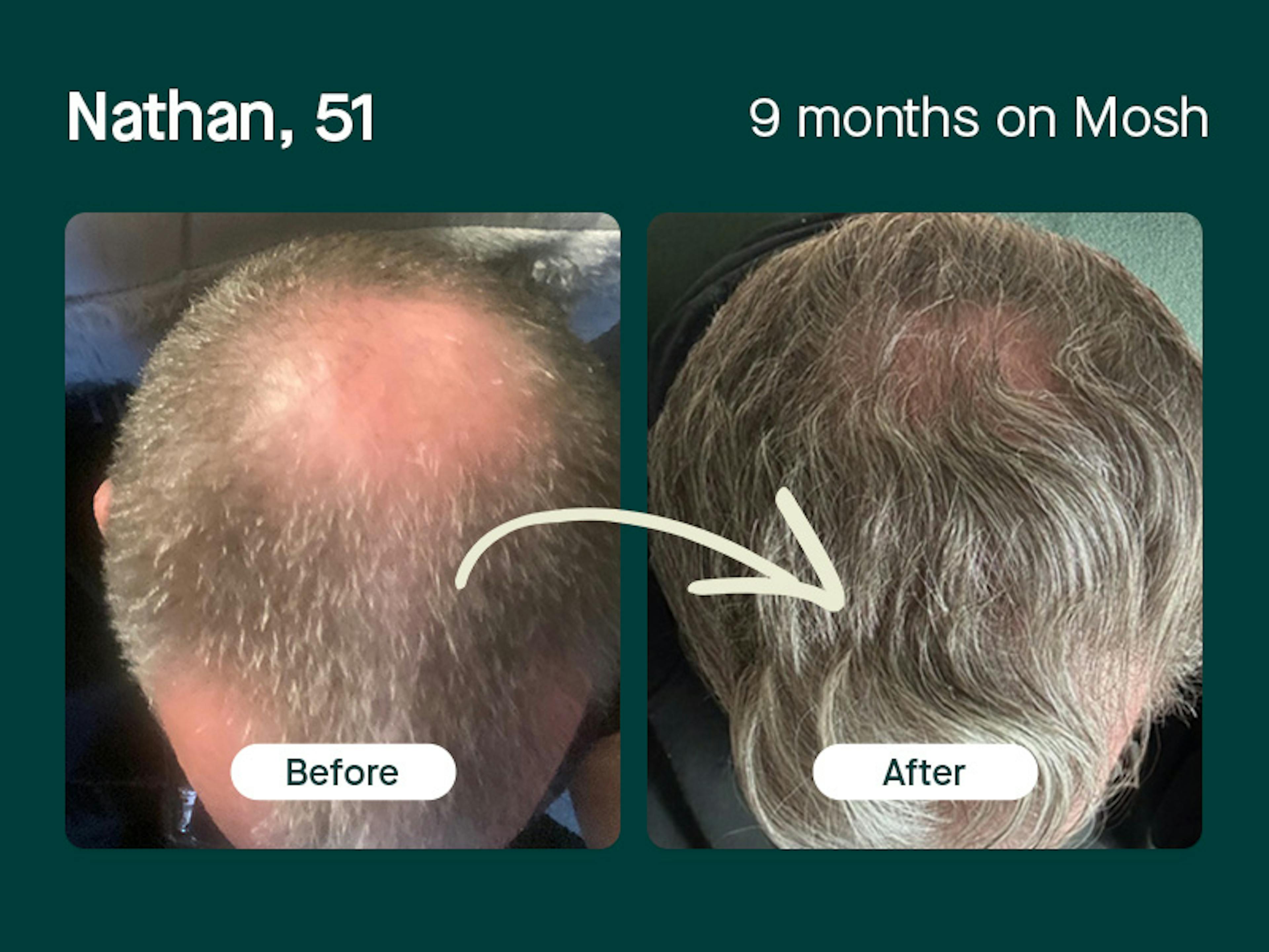 Nathan, 51yo regrowth hair in 9 months