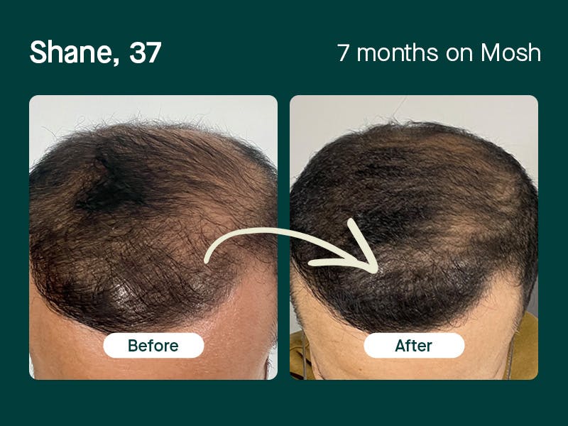 Shane, 37 regrowth hair in 7 months
