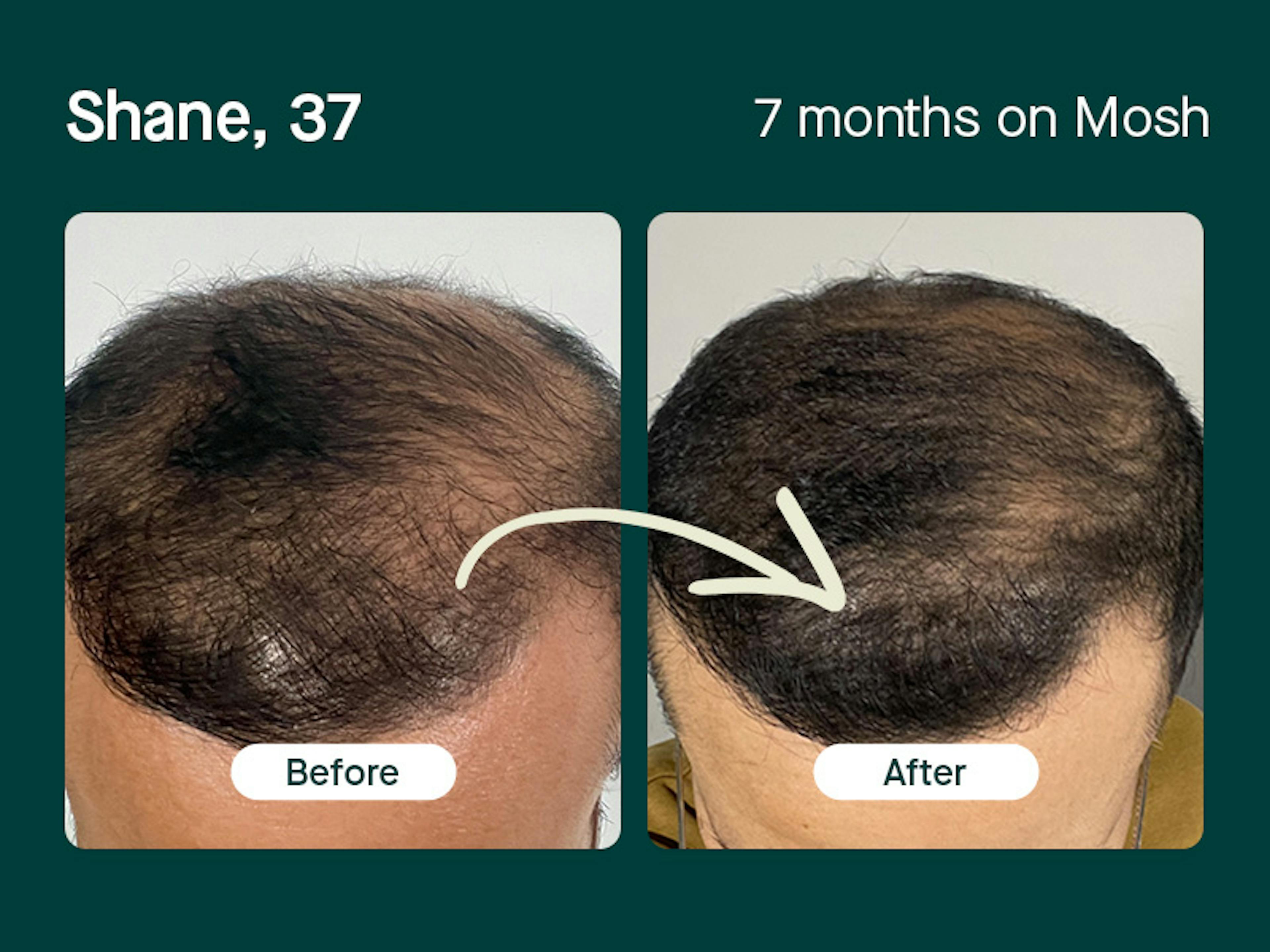 Shane, 37 regrowth hair in 7 months