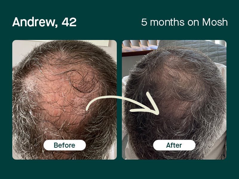 Andrew, 42yo regrowth hair in 5 months