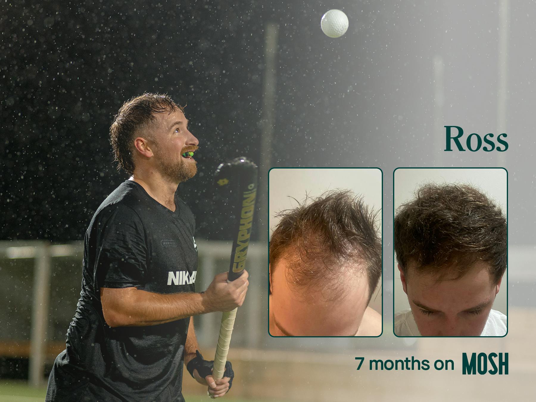 hair loss treatment before and after photo after 7 months