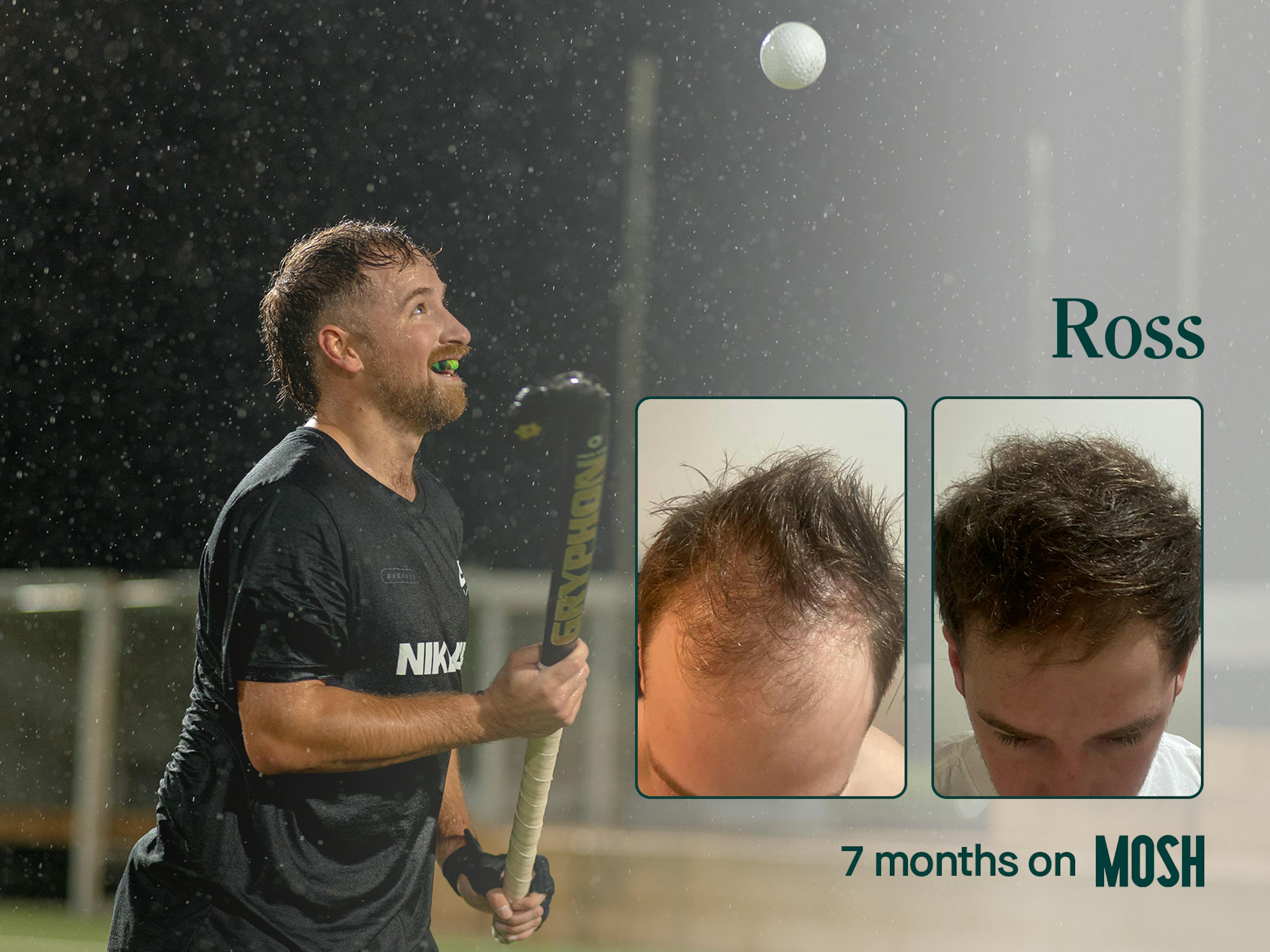 hair loss treatment before and after photo after 7 months