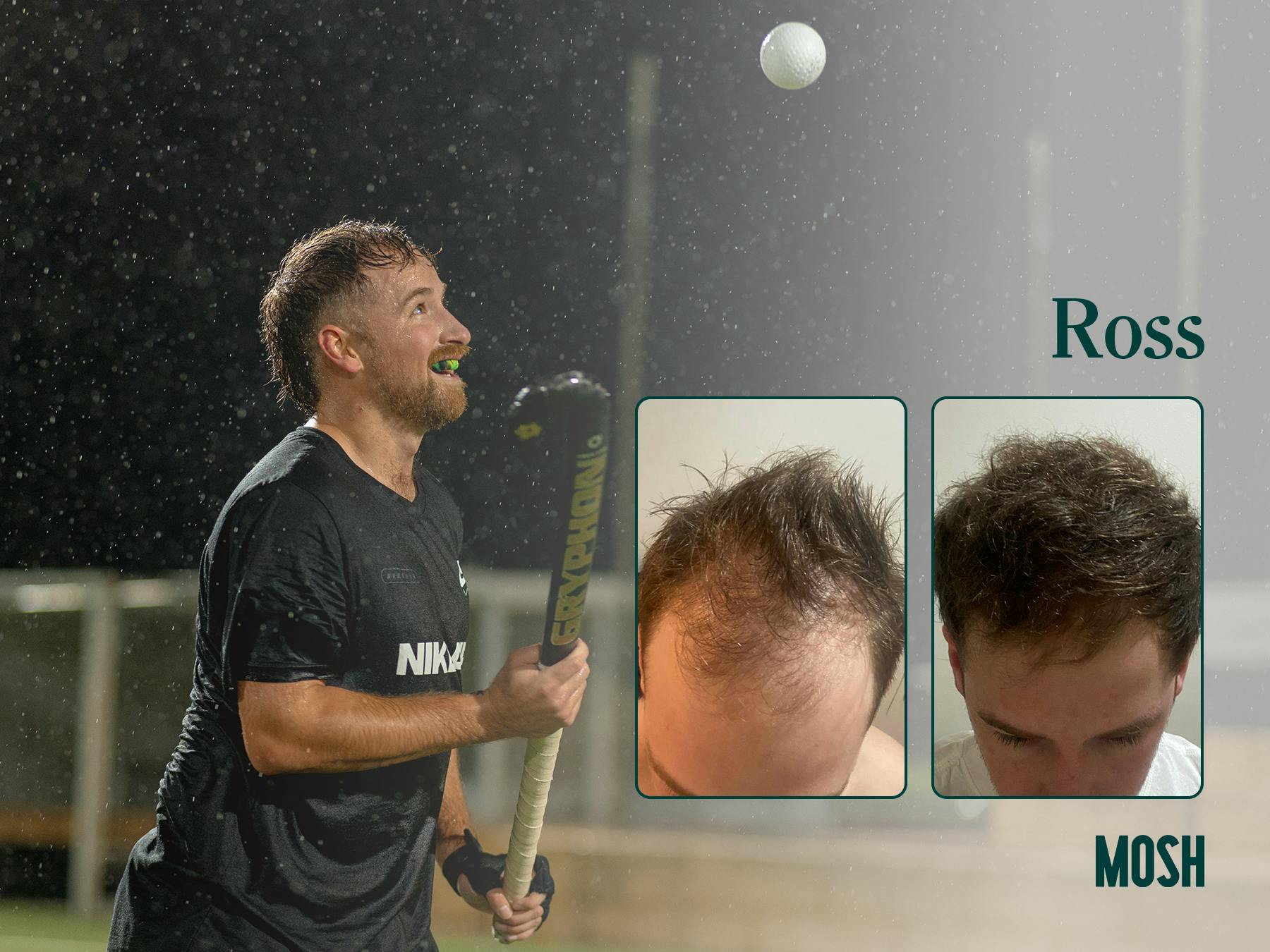 Mosh hair loss treatment before and after - Ross