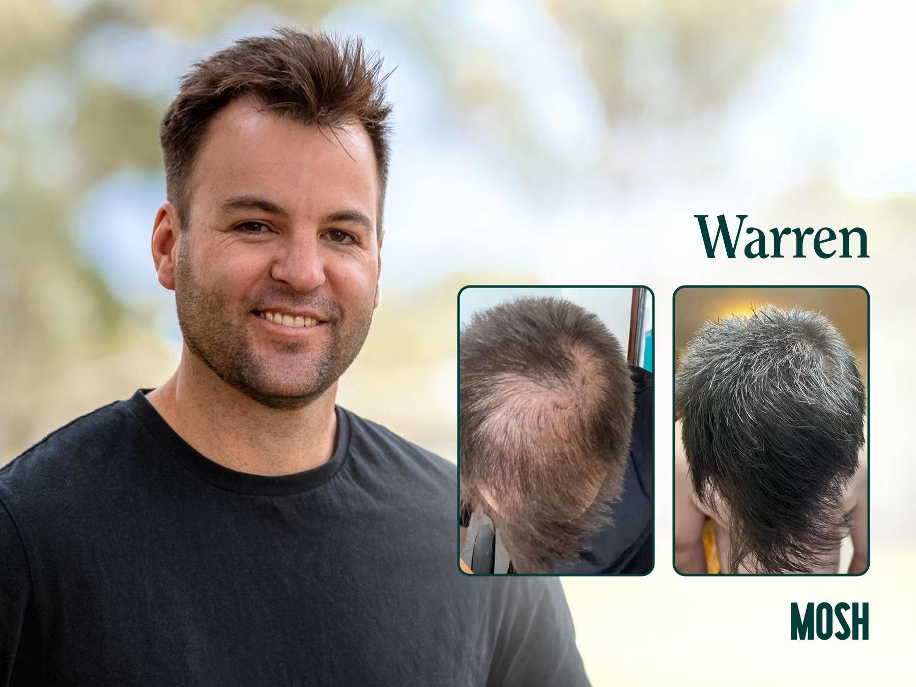 Mosh hair loss treatment before and after -Warren