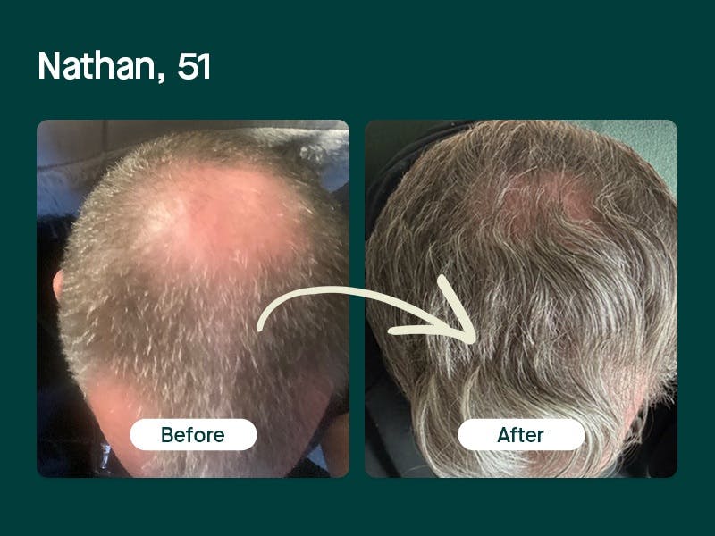 Mosh's hair loss treatment before and after - Will