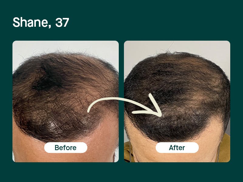 Mosh's hair loss treatment before and after  - Shane