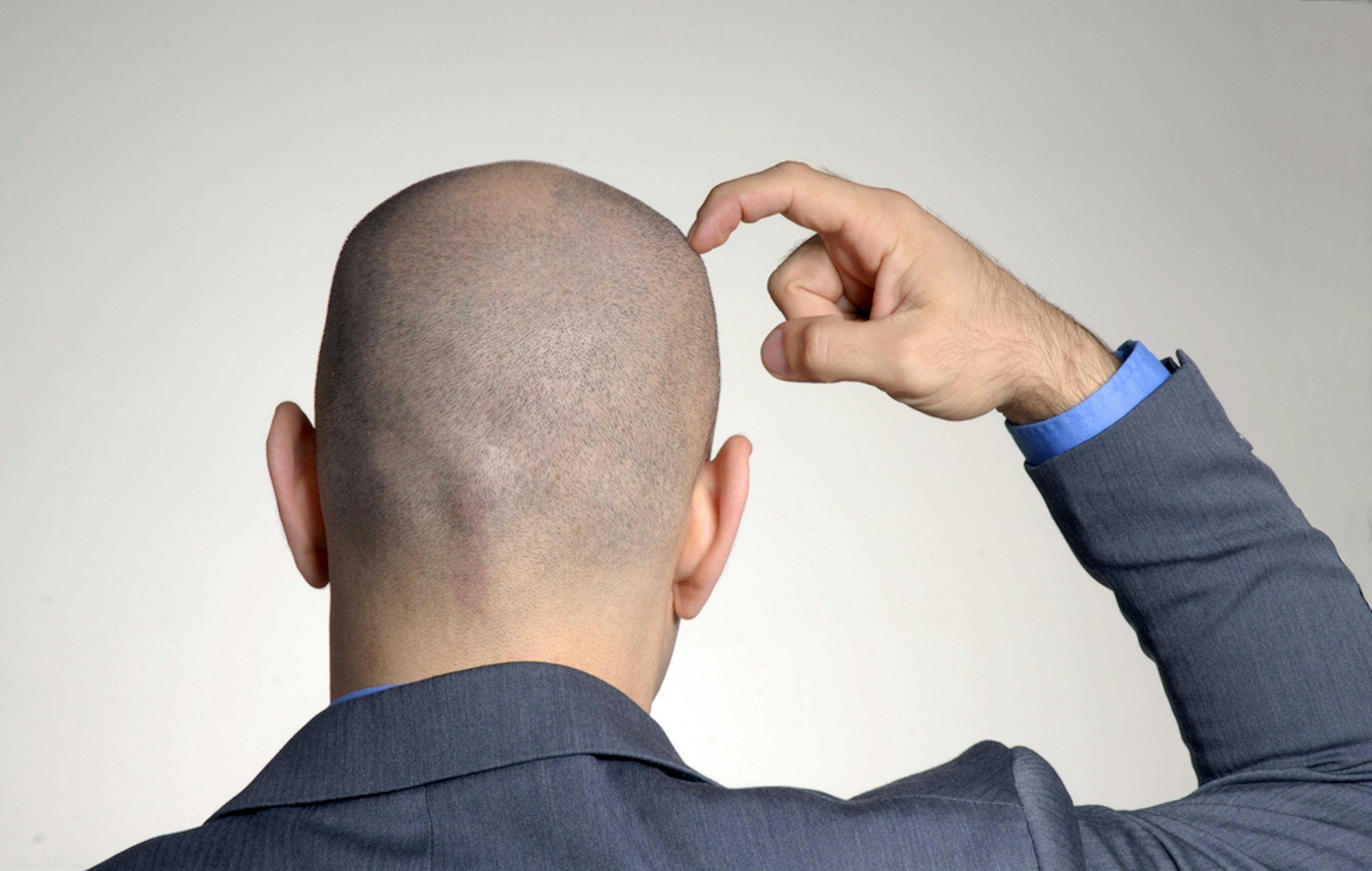 bald man thinking about hair loss