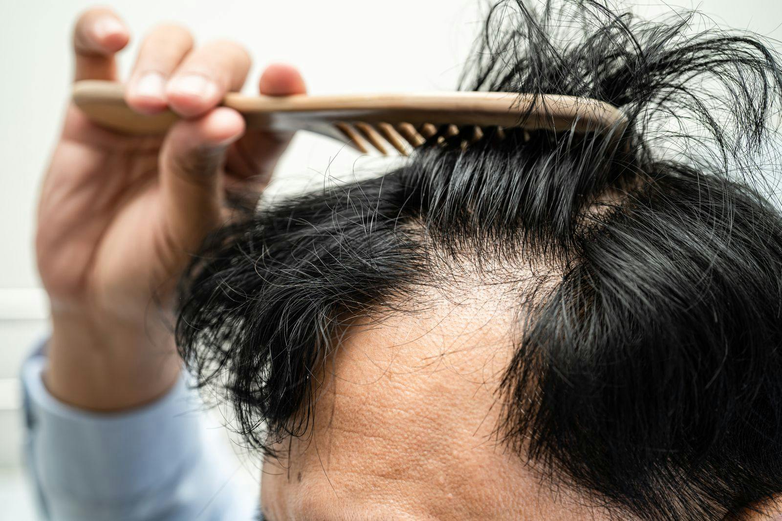Genetic prediction of male pattern baldness
