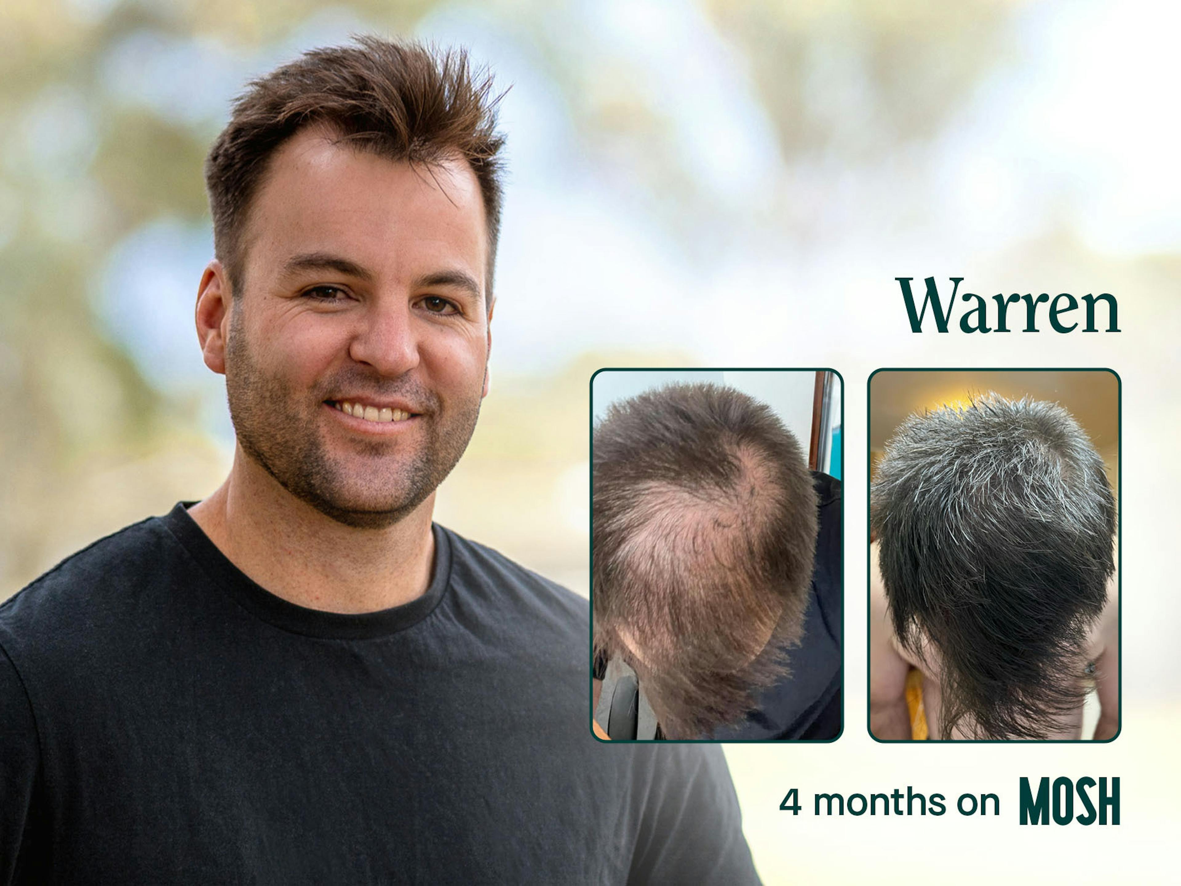 hair loss treatment before and after photo after 4 months