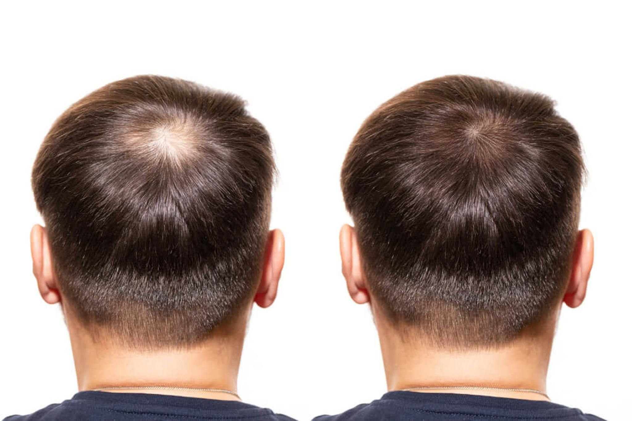 Man back head showing signs of hair loss