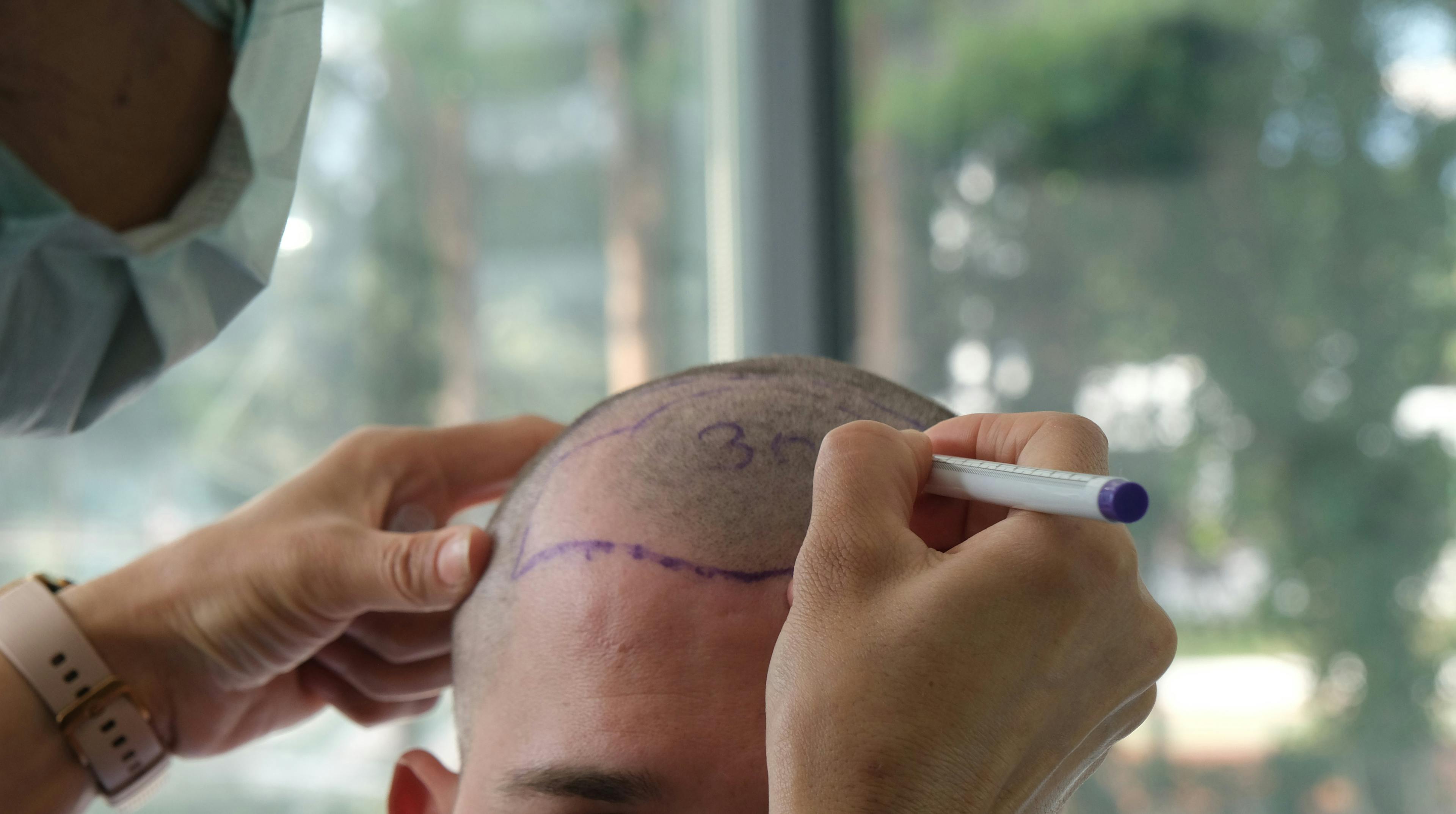 Hair Loss Treatment Brisbane
