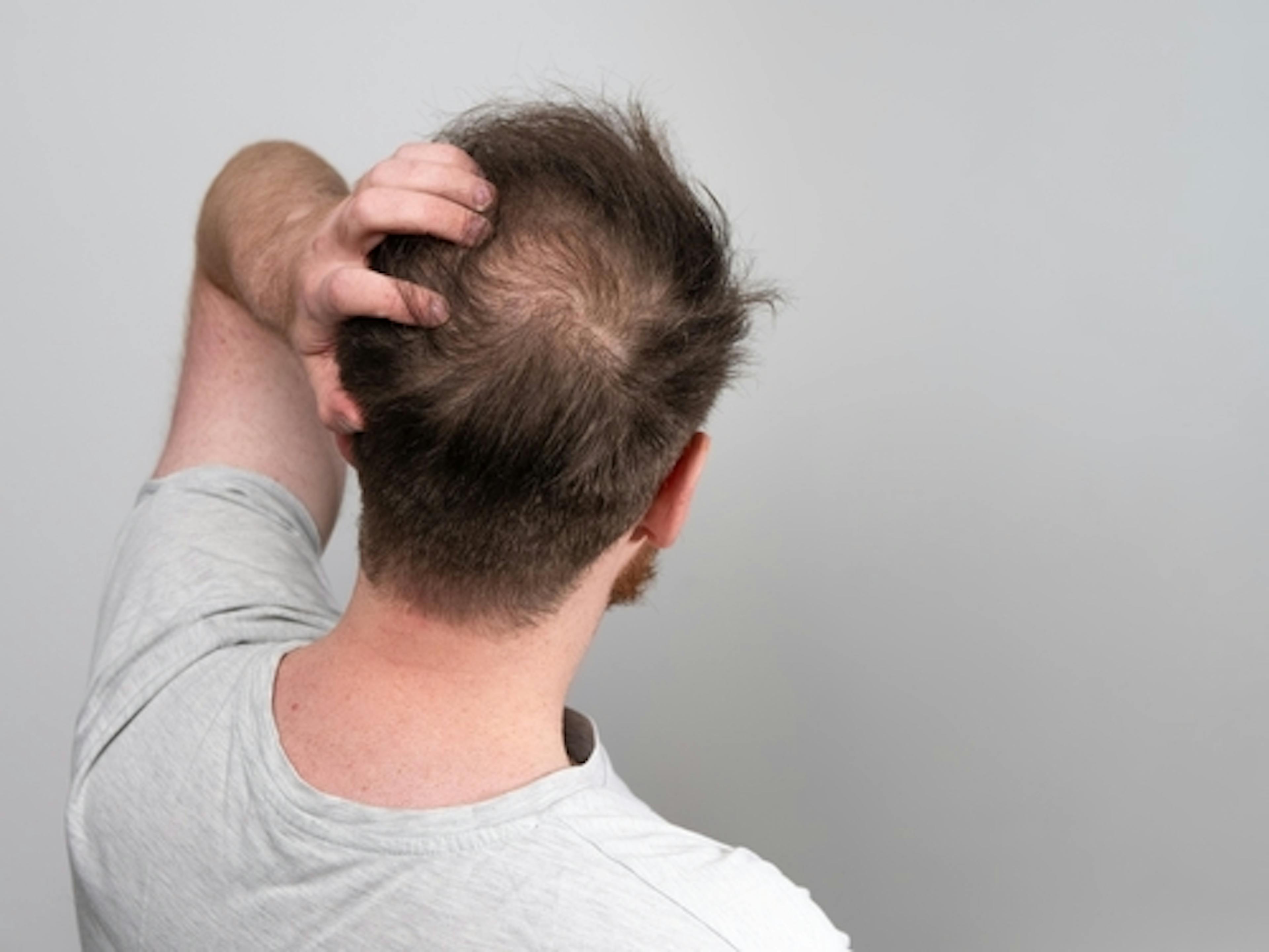 How Much Hair Loss Is Normal?