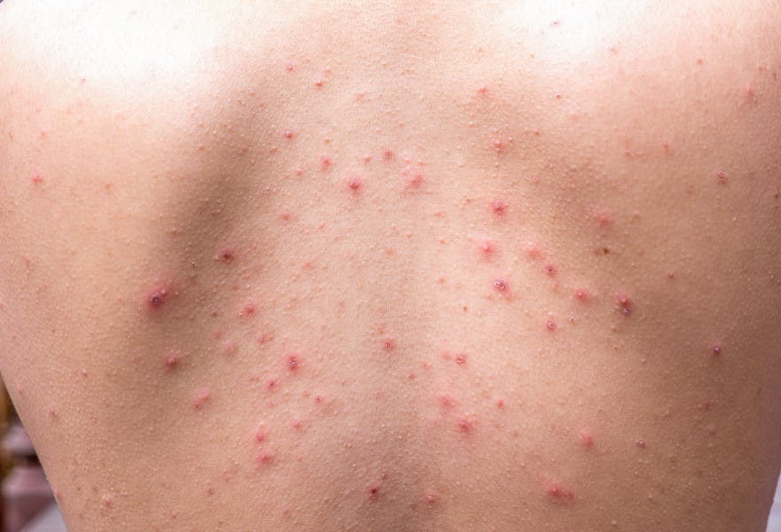 Comment éviter les cicatrices de varicelle ? | Pharmacien Giphar