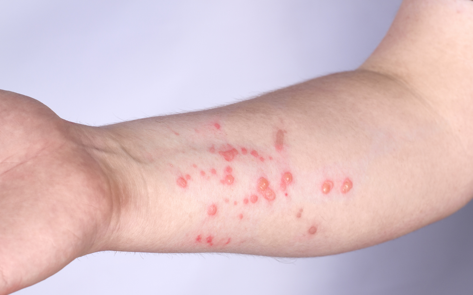 symptômes variole du singe MPOX