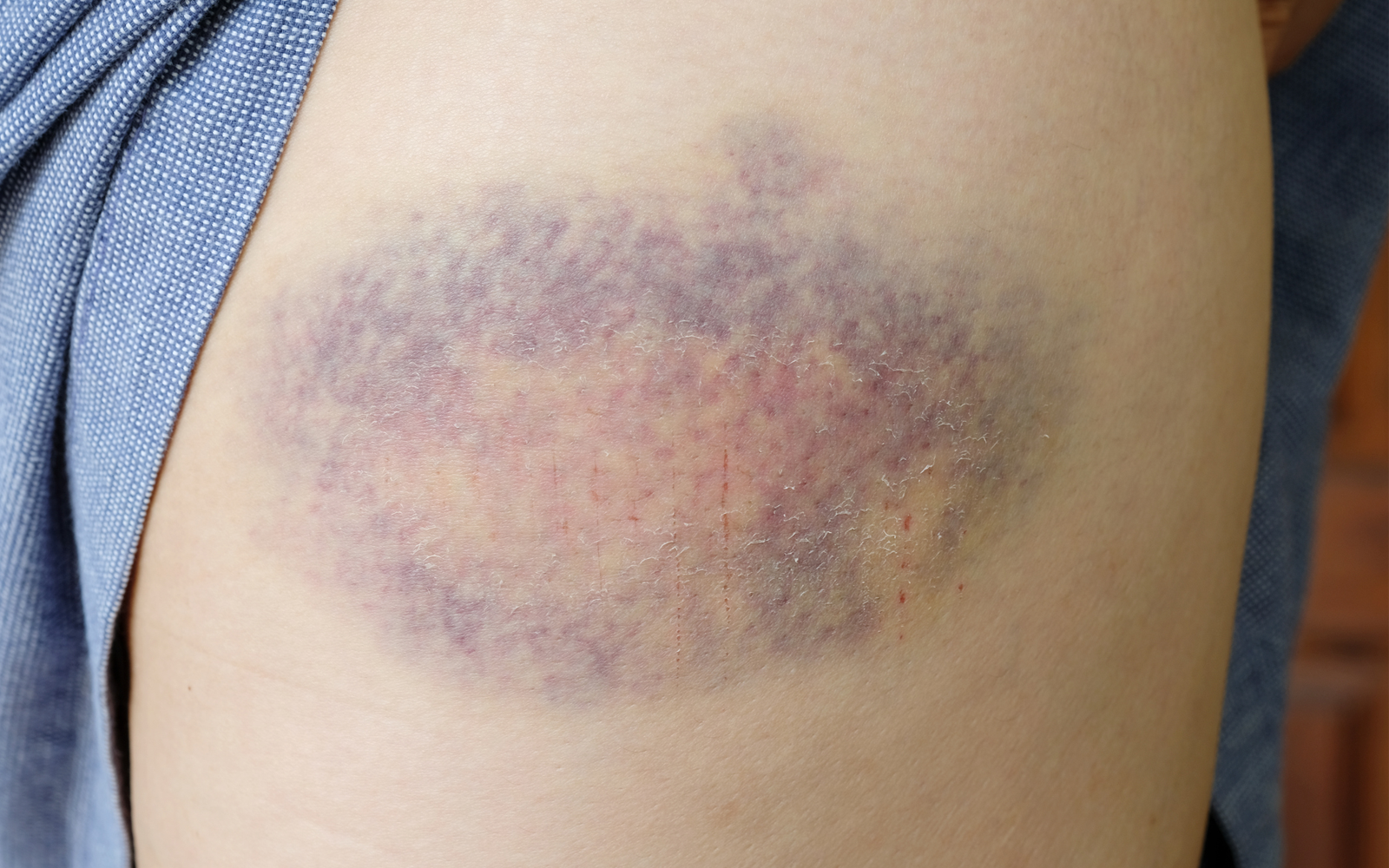 bien soigner un hématome