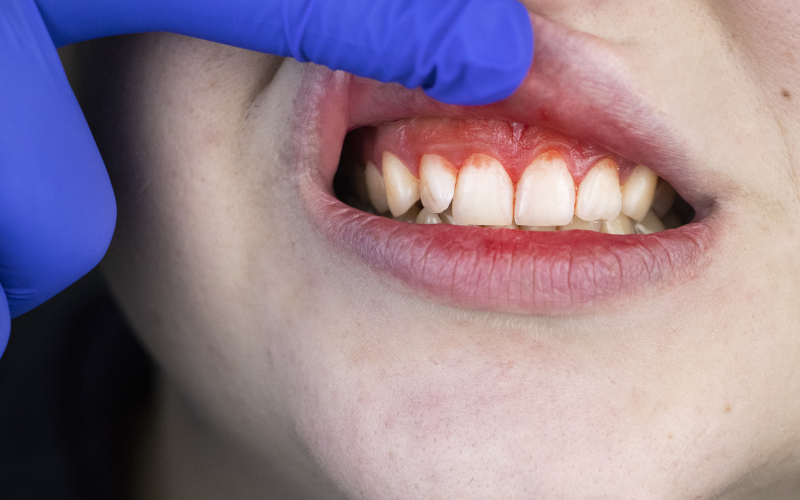 scorbut carence vitamine C