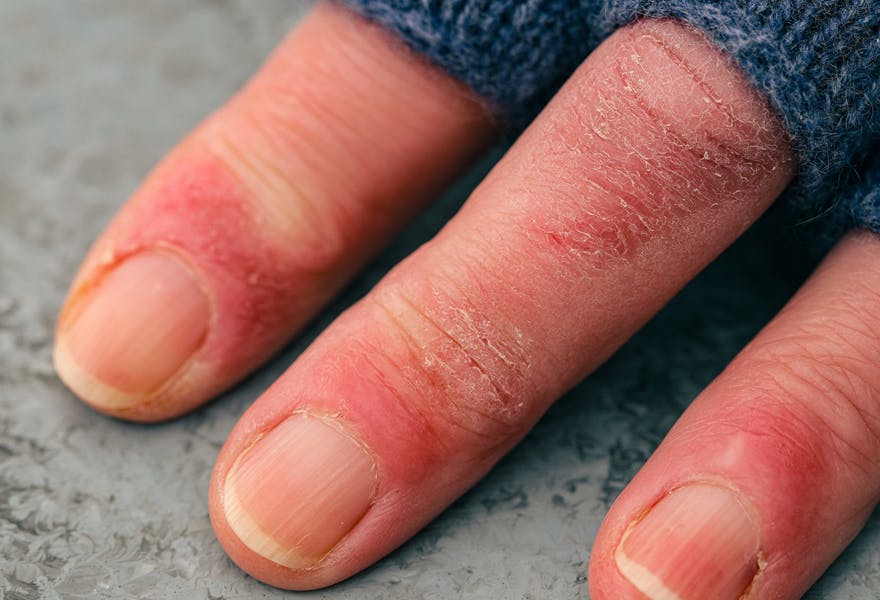 engelures mains froid hiver