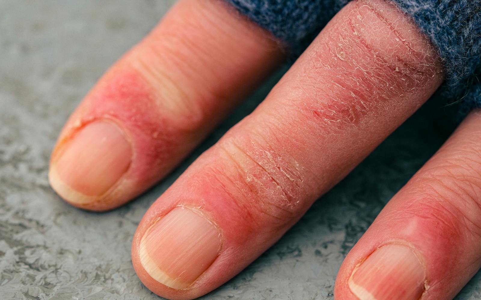 engelures aux mains froid hiver