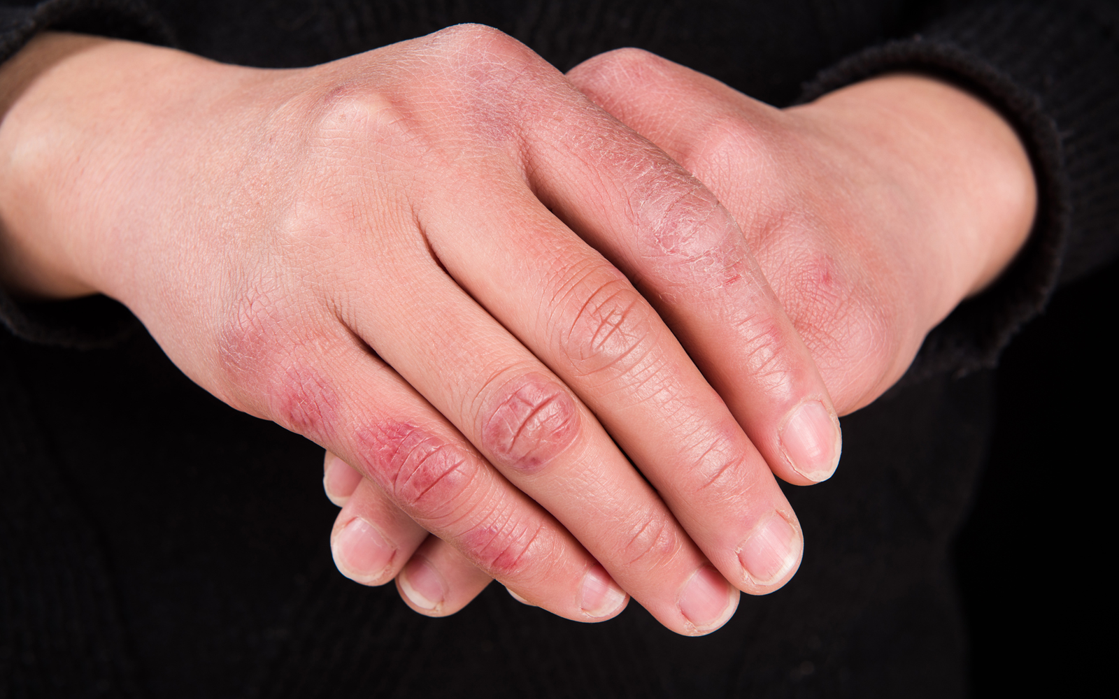 traitement engelures pieds mains