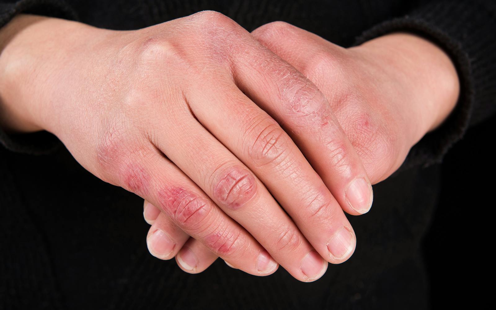 traitement engelures pieds mains