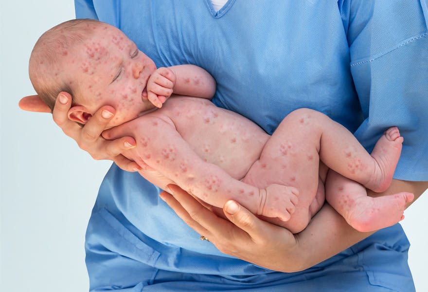 symptômes rougeole bébé