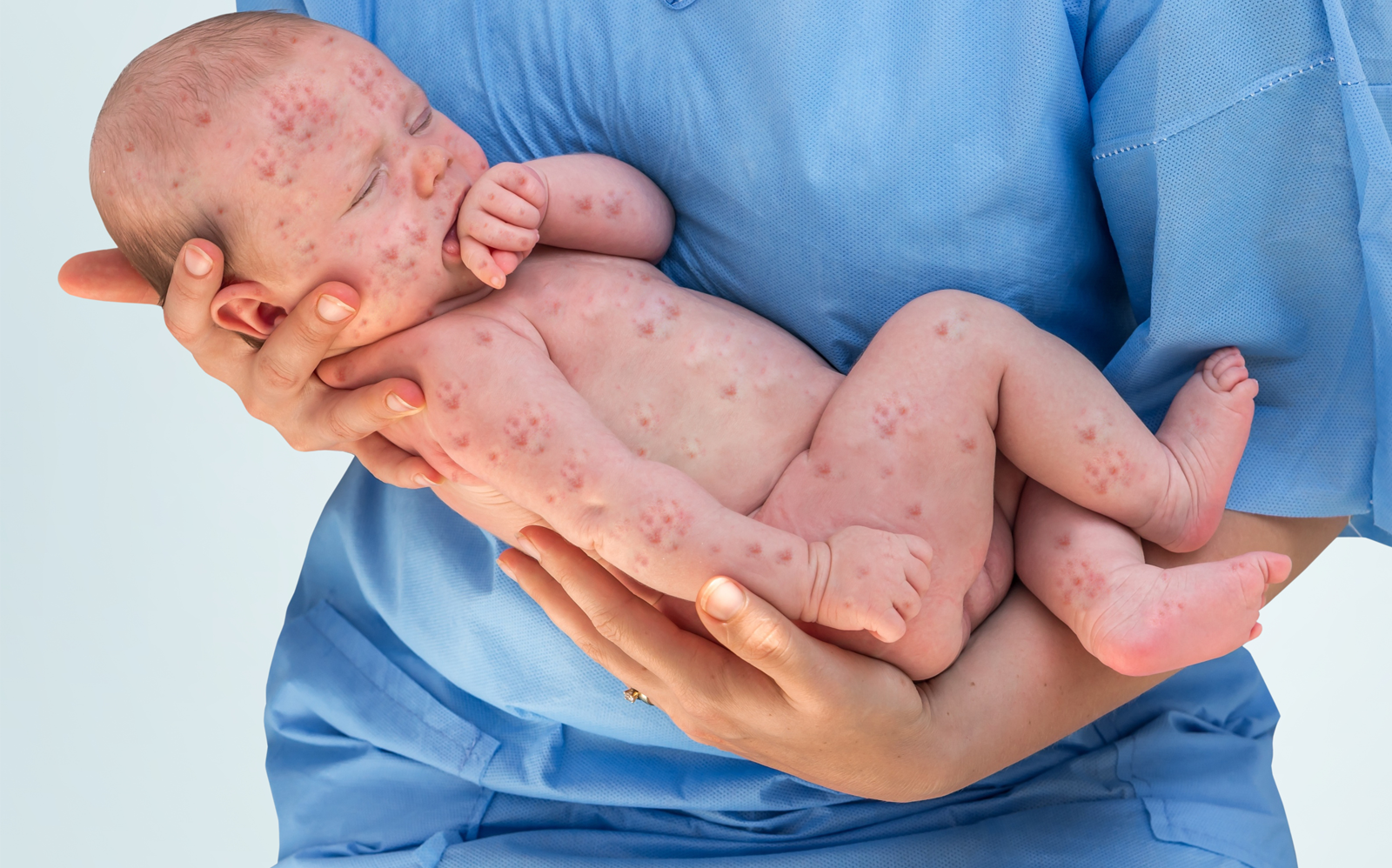 symptômes rougeole bébé