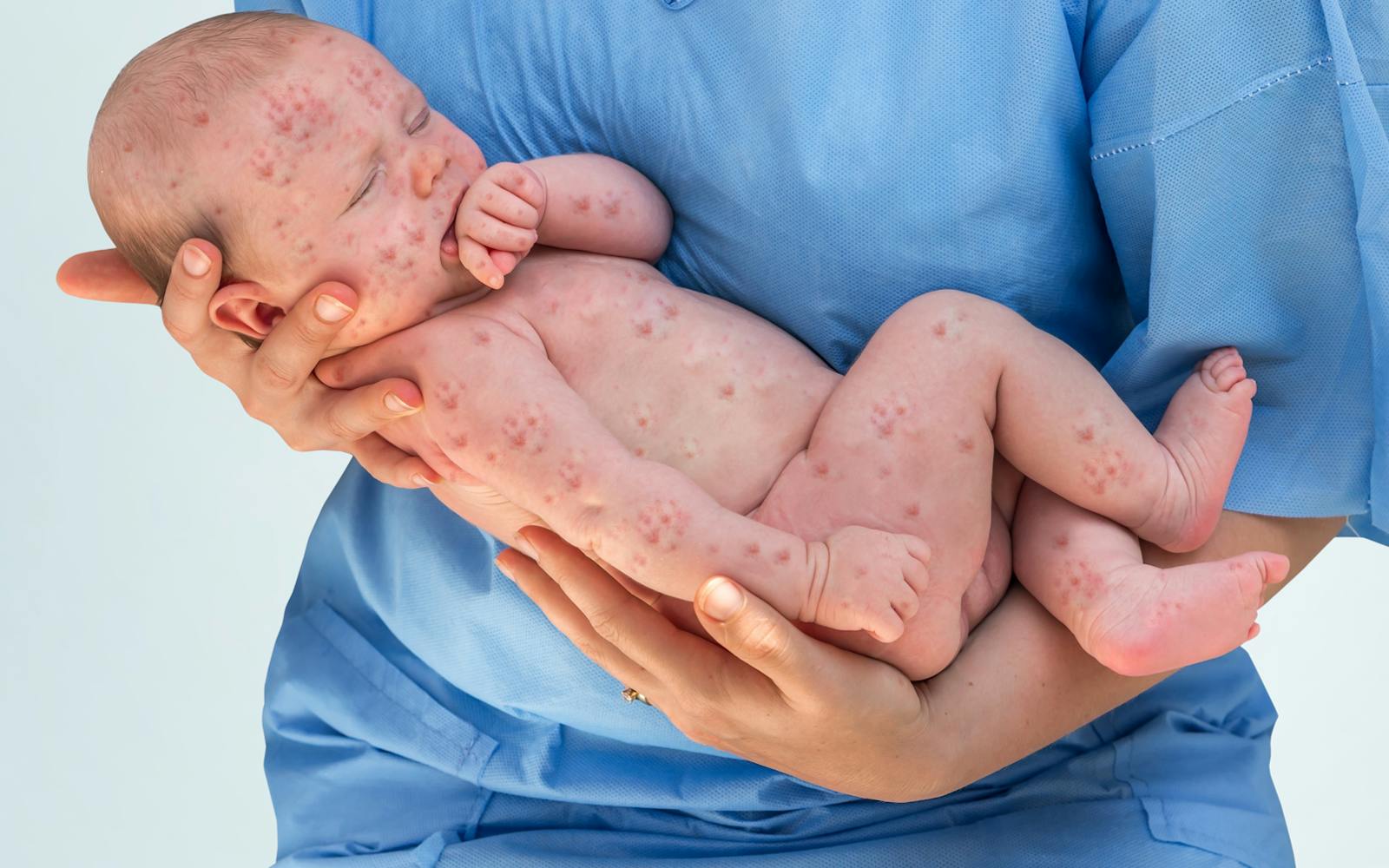 La rougeole chez le bébé : une maladie à éviter