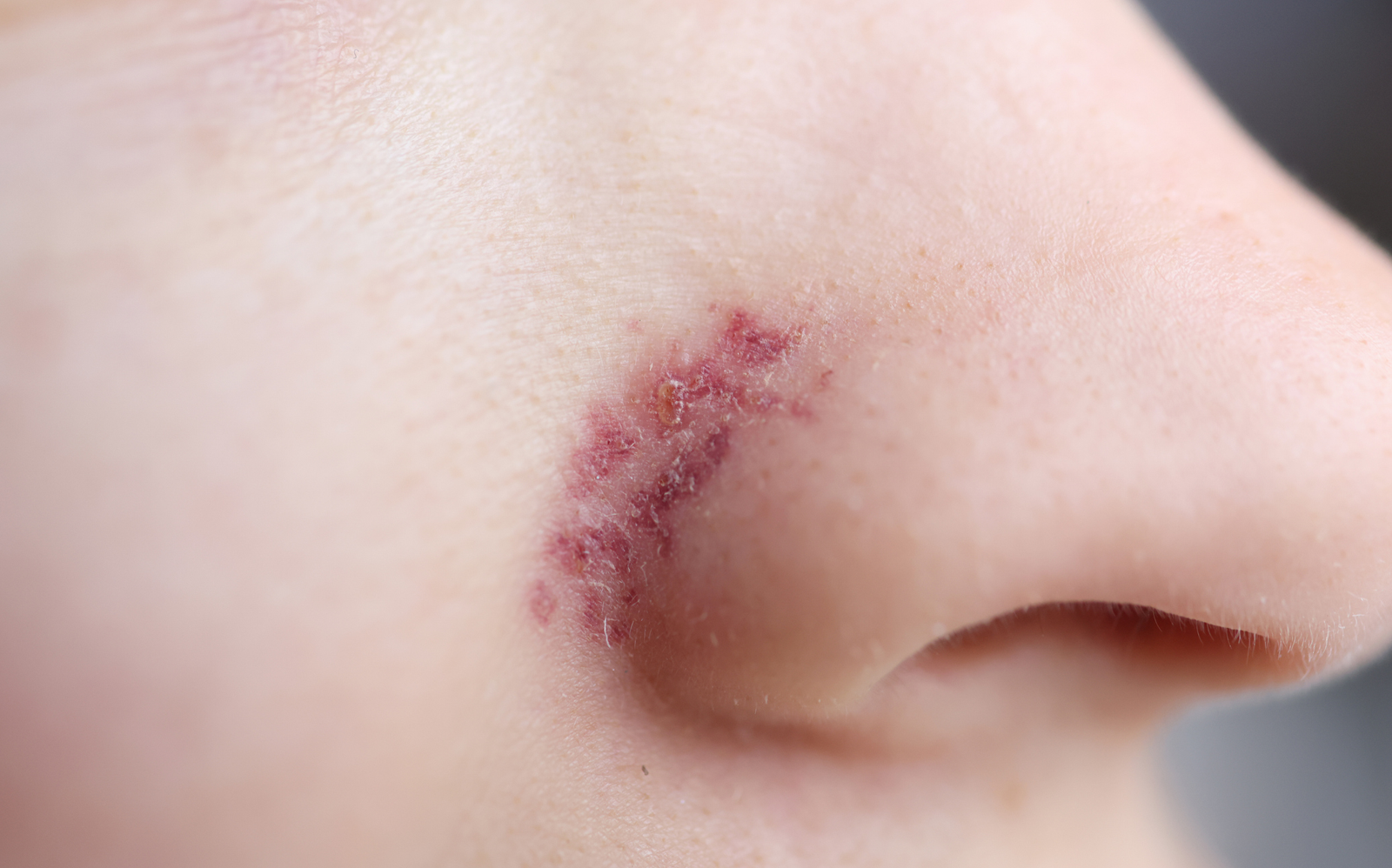 herpès visage que faire