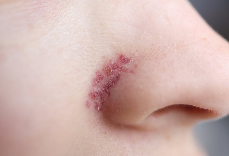 herpès visage que faire