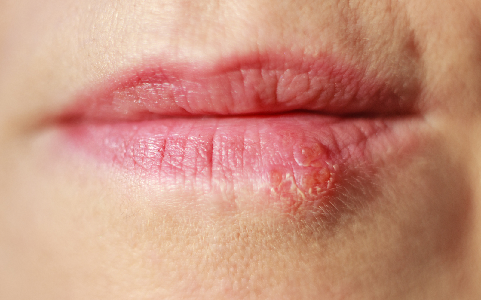 herpes buccale que faire