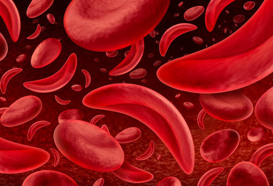 la drepanocytose
