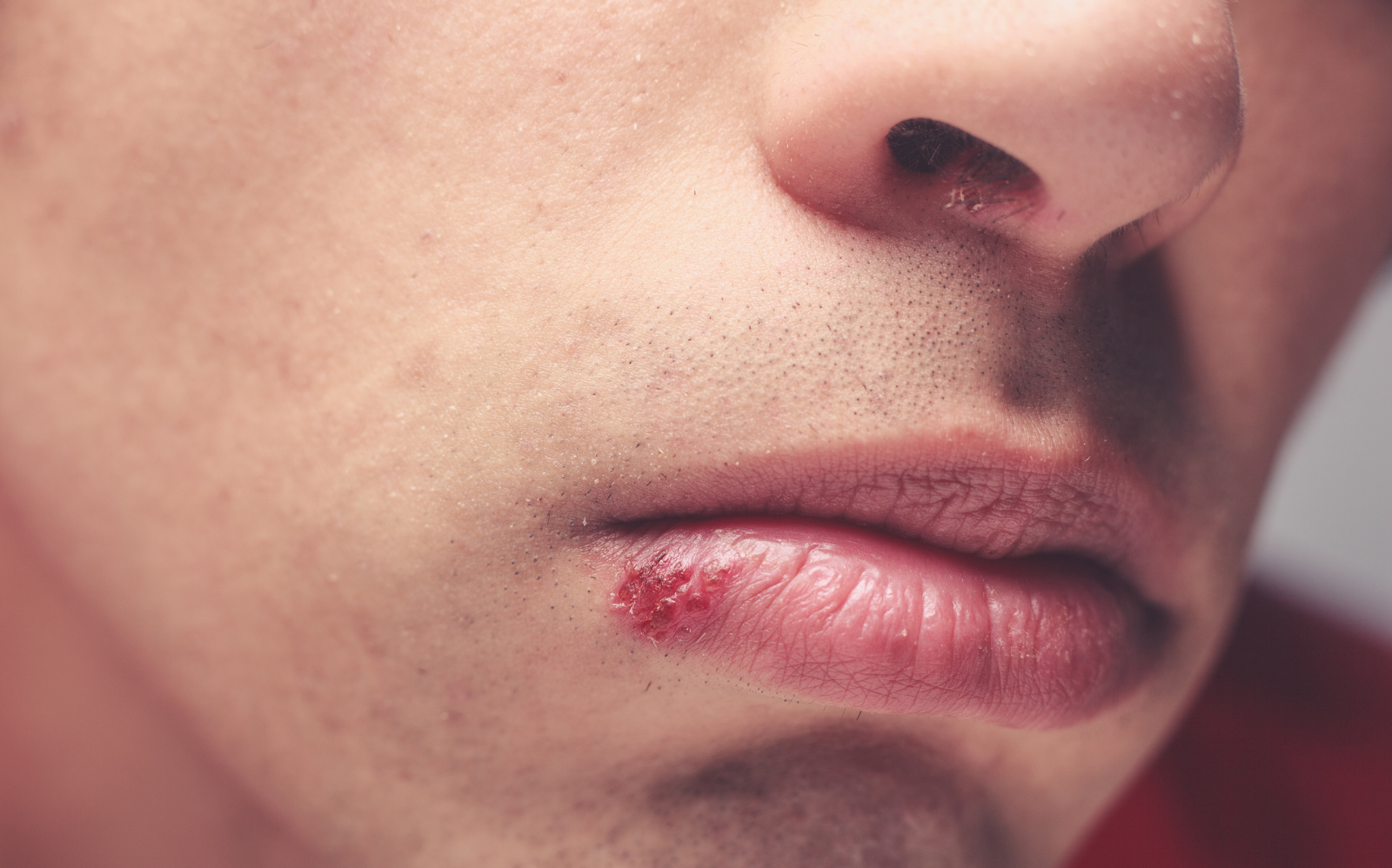 herpès labial