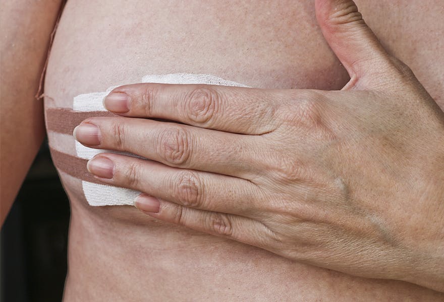 biopsie mammaire cancer du sein