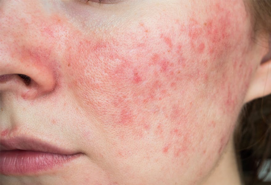 soins peau sensible et réactive Giphar