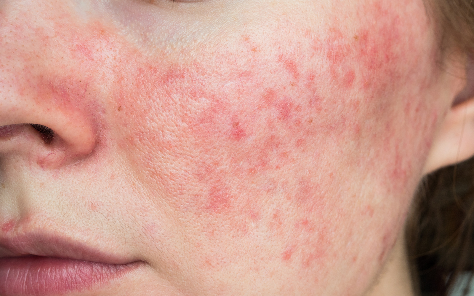 soins peau sensible et réactive Giphar